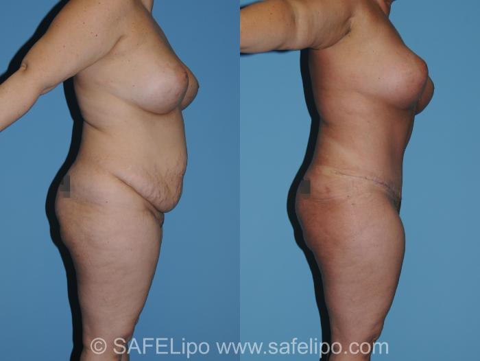 Abdominoplasty Right Side Photo, Shreveport, LA, The Wall Center for Plastic Surgery, Case 314