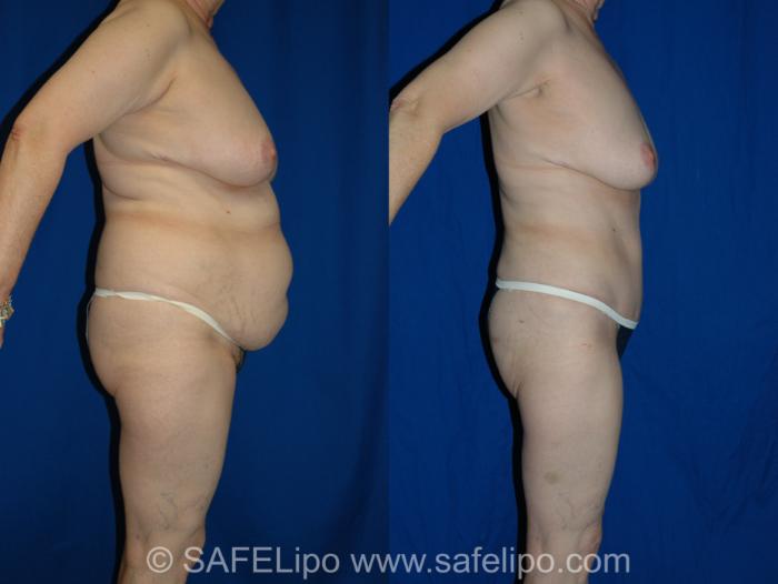Abdominoplasty Right Side Photo, Shreveport, LA, The Wall Center for Plastic Surgery, Case 315