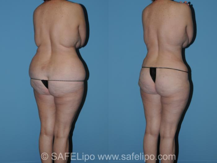 Abdominoplasty Back L Oblique Photo, Shreveport, LA, The Wall Center for Plastic Surgery, Case 316