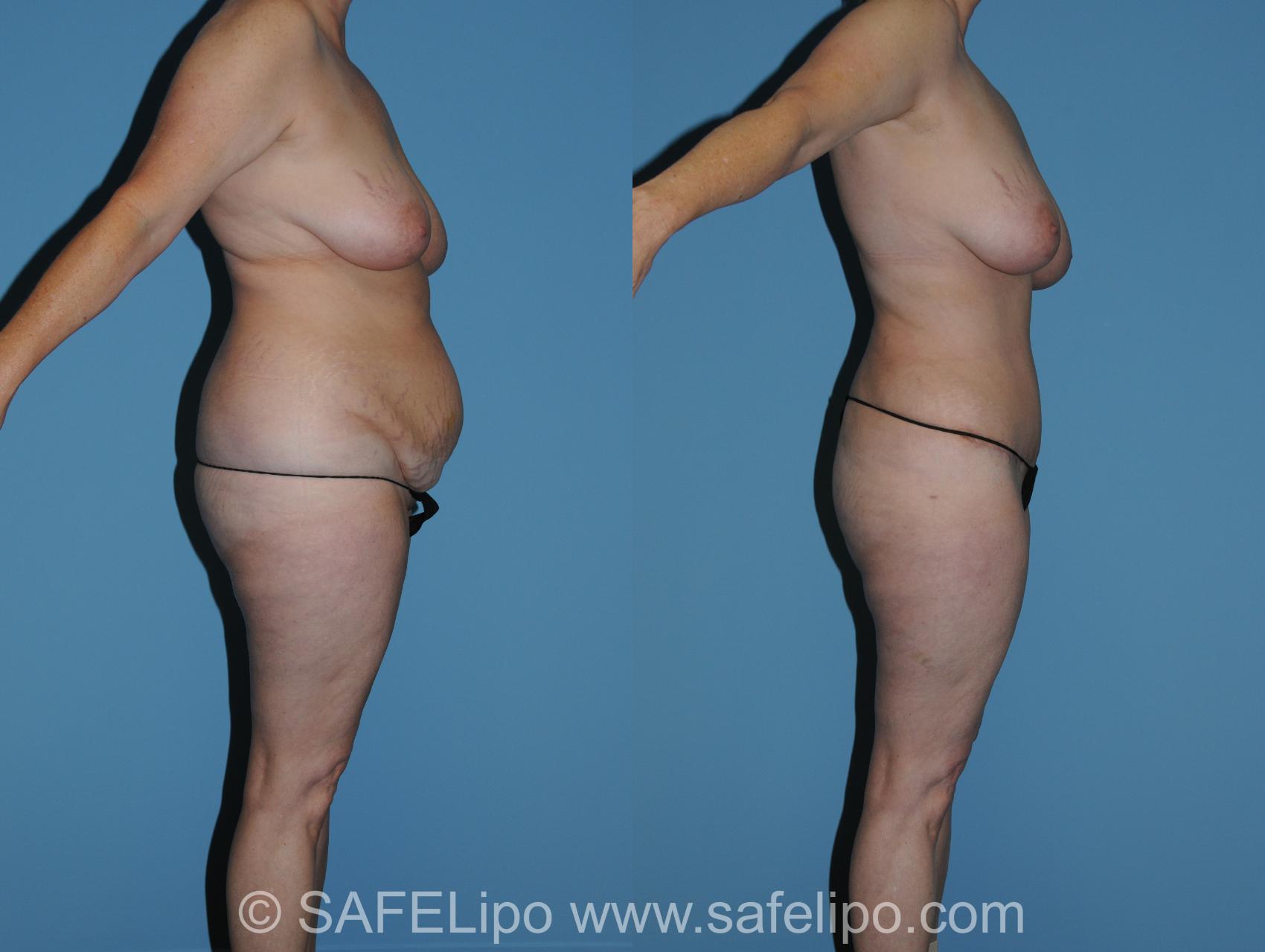 Abdominoplasty Right Side Photo, Shreveport, LA, The Wall Center for Plastic Surgery, Case 316