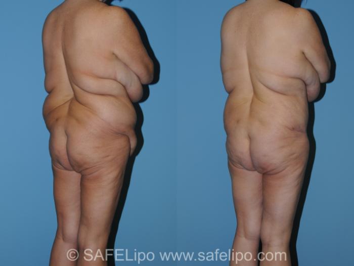 Abdominoplasty Back R Oblique Photo, Shreveport, LA, The Wall Center for Plastic Surgery, Case 317