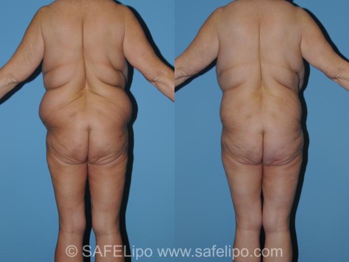 Abdominoplasty Back Photo, Shreveport, Louisiana, The Wall Center for Plastic Surgery, Case 317