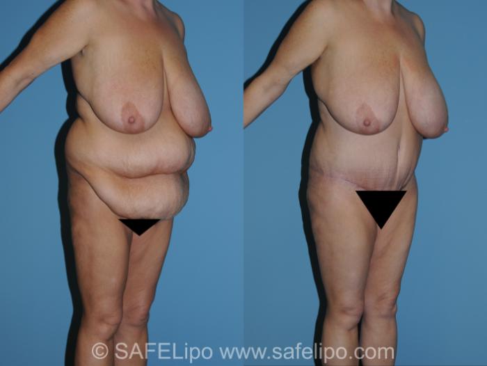 Abdominoplasty Right Oblique Photo, Shreveport, LA, The Wall Center for Plastic Surgery, Case 317