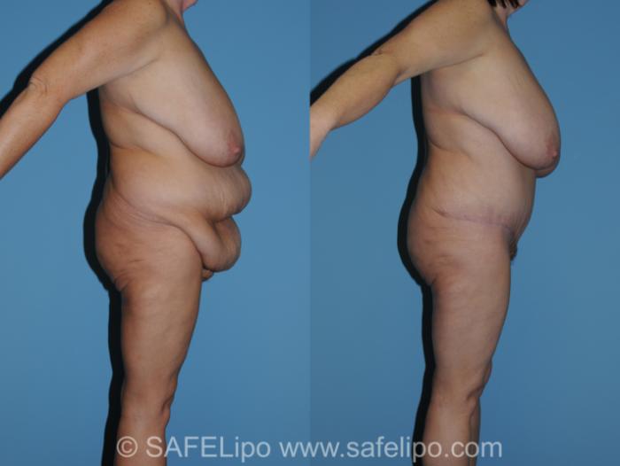 Abdominoplasty Right Side Photo, Shreveport, LA, The Wall Center for Plastic Surgery, Case 317