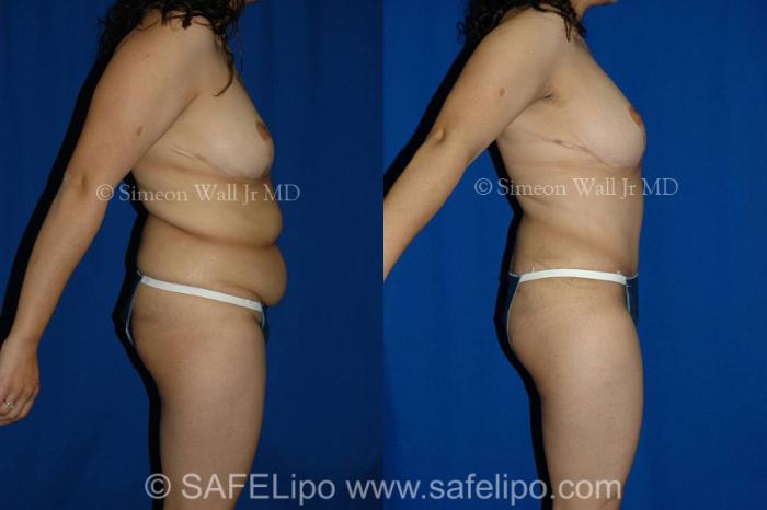 Tummy Tuck Case 320 Before & After View #3 | SAFELipo®