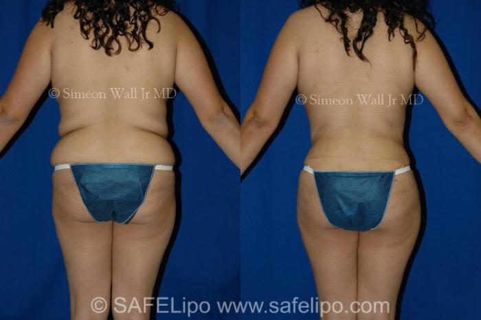 SAFELipoHD® Case 320 Before & After View #4 | SAFELipo®