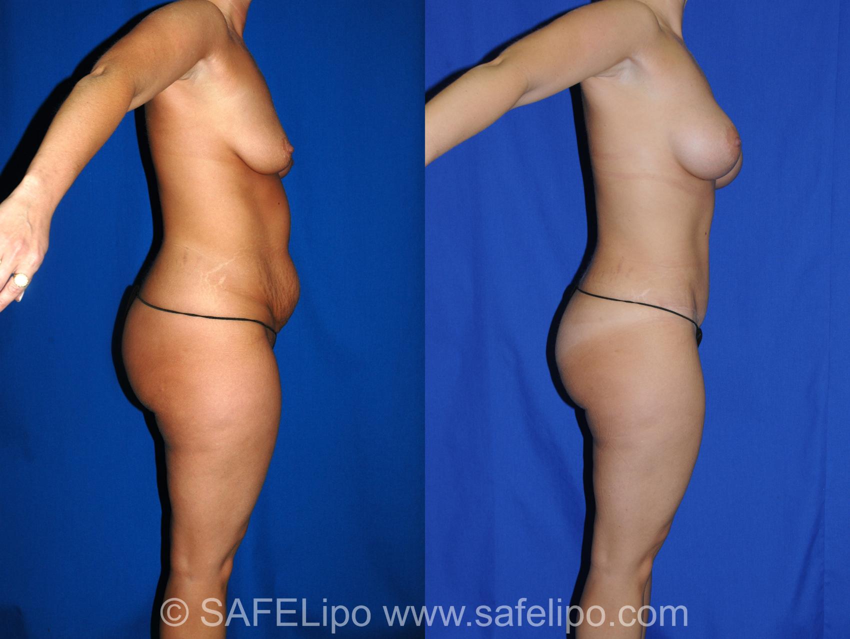 Abdominoplasty Right Side Photo, Shreveport, LA, The Wall Center for Plastic Surgery, Case 323