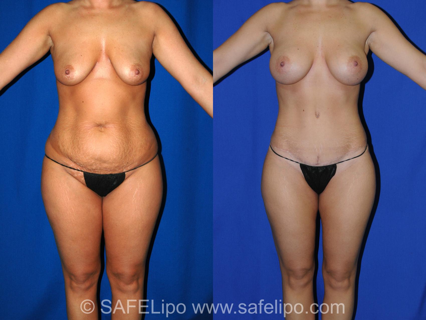 Tummy Tuck Case 323 Before & After View #1 | SAFELipo®