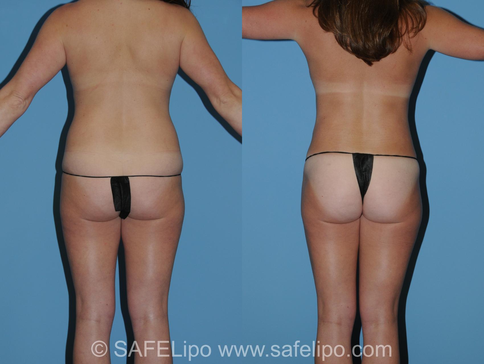 Abdominoplasty Back Photo, Shreveport, Louisiana, The Wall Center for Plastic Surgery, Case 325