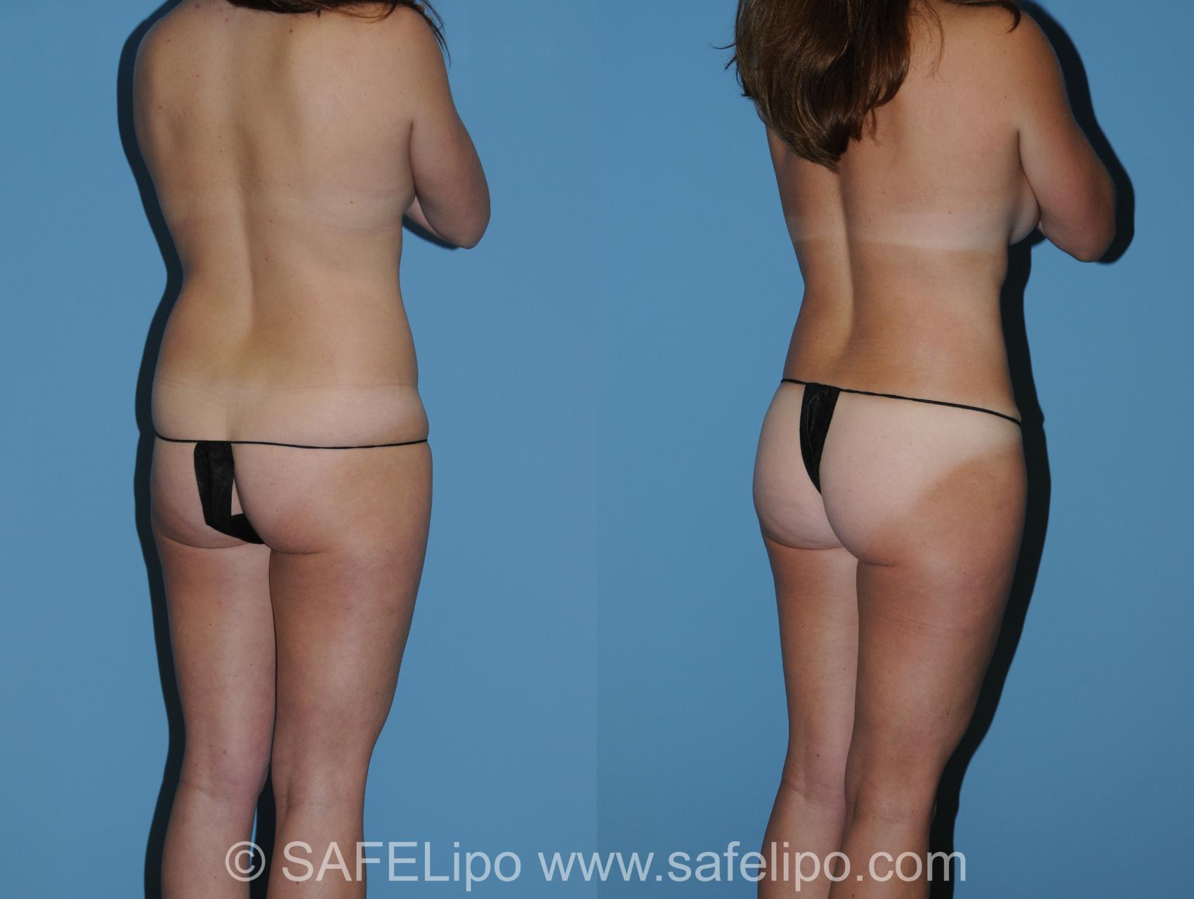 Abdominoplasty Back R Oblique Photo, Shreveport, LA, The Wall Center for Plastic Surgery, Case 325