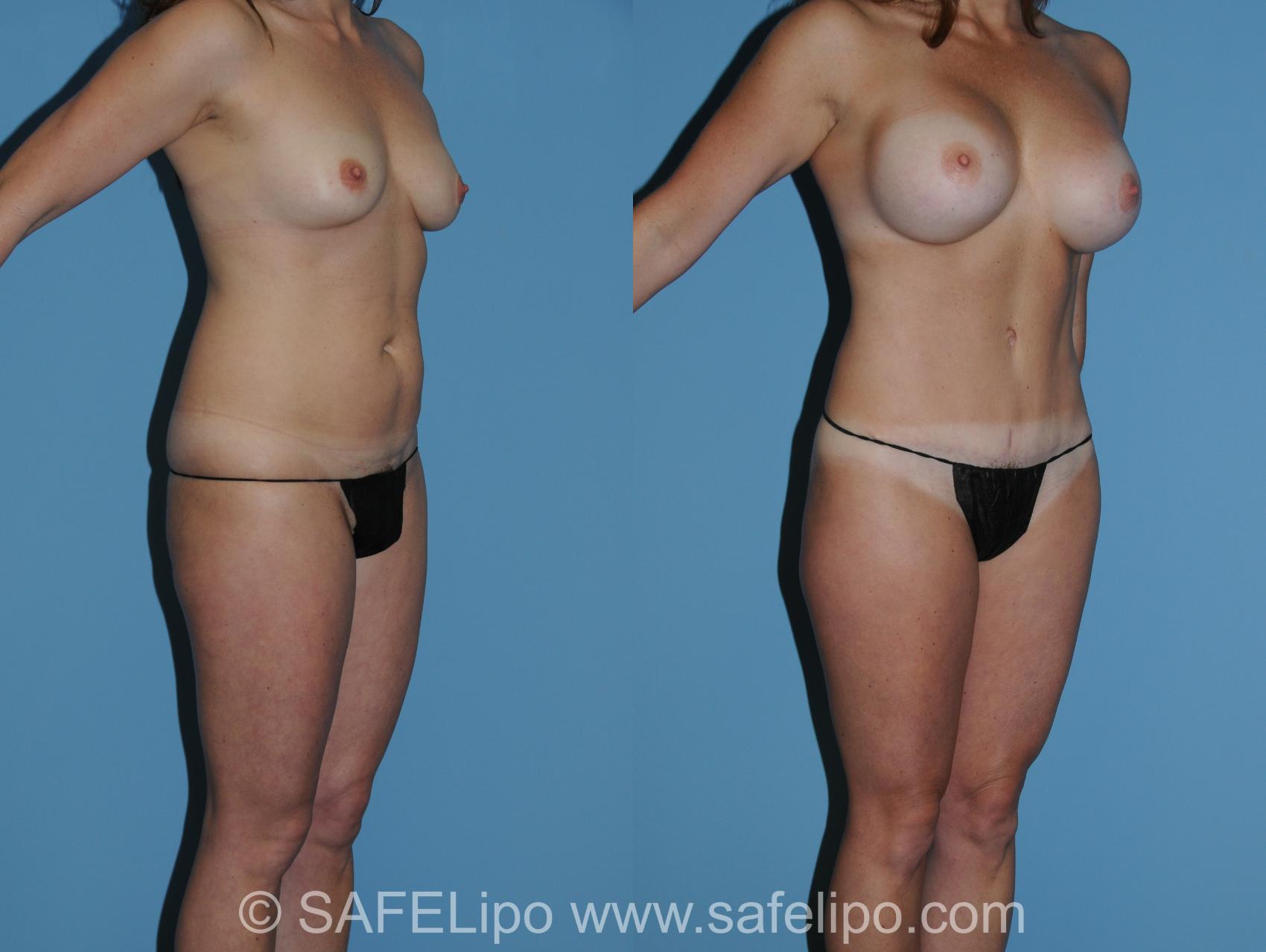 Abdominoplasty Right Oblique Photo, Shreveport, LA, The Wall Center for Plastic Surgery, Case 325