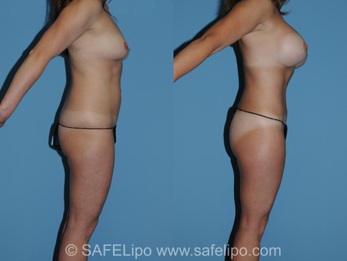 Abdominoplasty Right Side Photo, Shreveport, LA, The Wall Center for Plastic Surgery, Case 325
