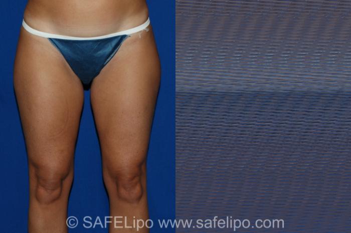 Abdominoplasty Front Thighs Photo, Shreveport, LA, The Wall Center for Plastic Surgery, Case 326