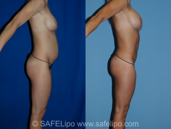 SAFELipoHD® Case 327 Before & After View #3 | SAFELipo®