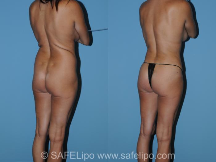 Abdominoplasty Back R Oblique Photo, Shreveport, LA, The Wall Center for Plastic Surgery, Case 328