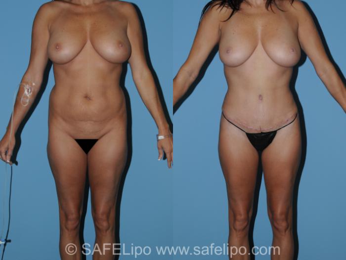SAFELipo® SSBA for Butt Lifting Case 328 Before & After View #1 | SAFELipo®