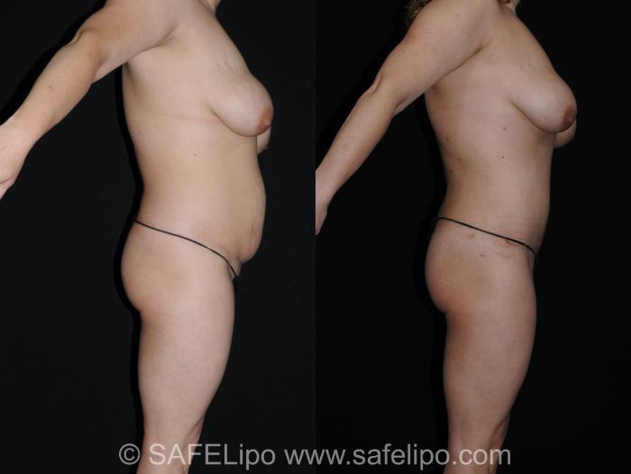 Abdominoplasty Right Side Photo, Shreveport, LA, The Wall Center for Plastic Surgery, Case 331