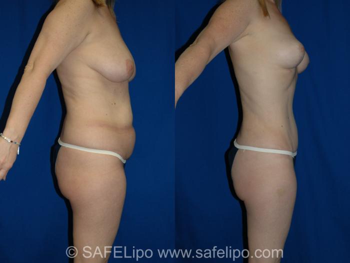 Abdominoplasty Right Side Photo, Shreveport, LA, The Wall Center for Plastic Surgery, Case 345