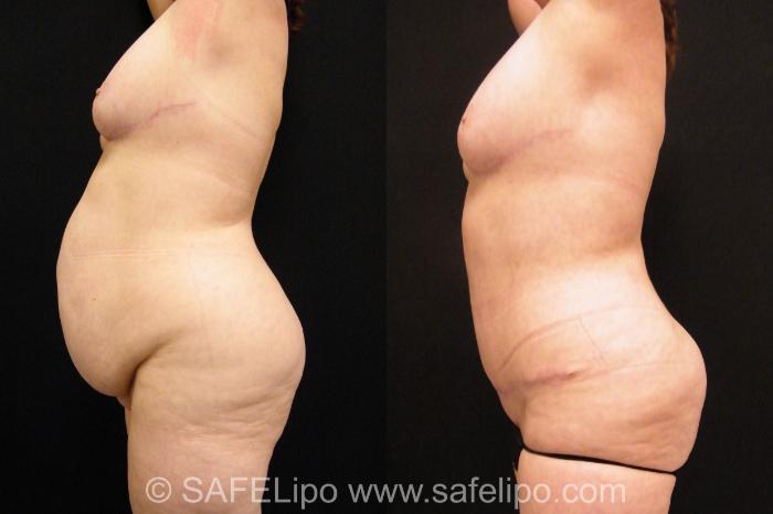 Tummy Tuck Case 392 Before & After View #2 | SAFELipo®
