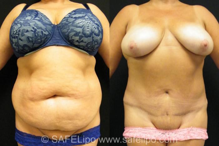 Tummy Tuck Case 394 Before & After View #1 | SAFELipo®
