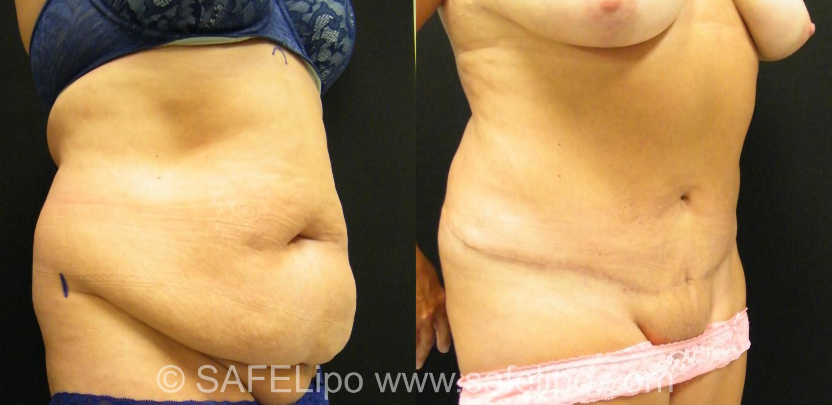 Tummy Tuck Case 394 Before & After View #2 | SAFELipo®