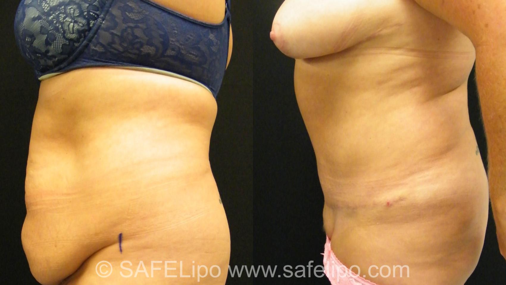 Tummy Tuck Case 394 Before & After View #3 | SAFELipo®