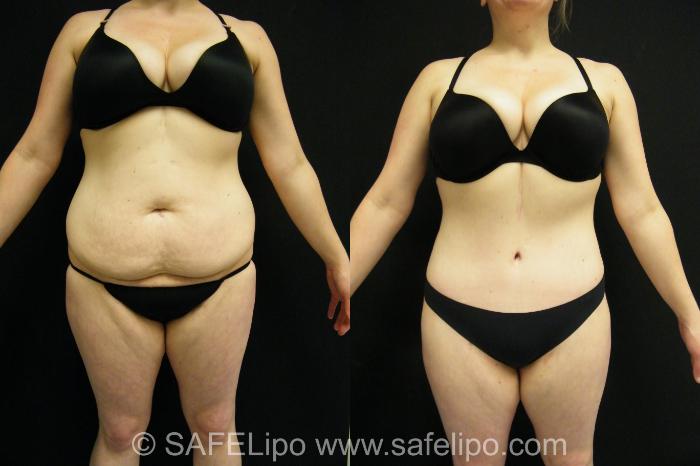 Tummy Tuck Case 398 Before & After View #1 | SAFELipo®