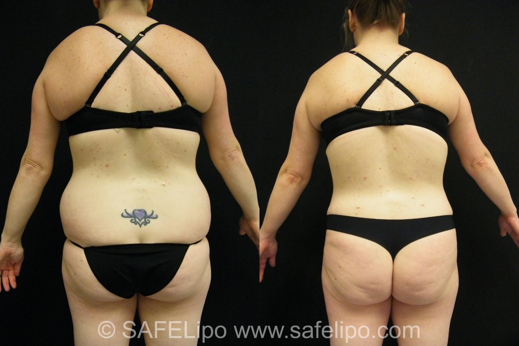 Tummy Tuck Case 398 Before & After View #2 | SAFELipo®