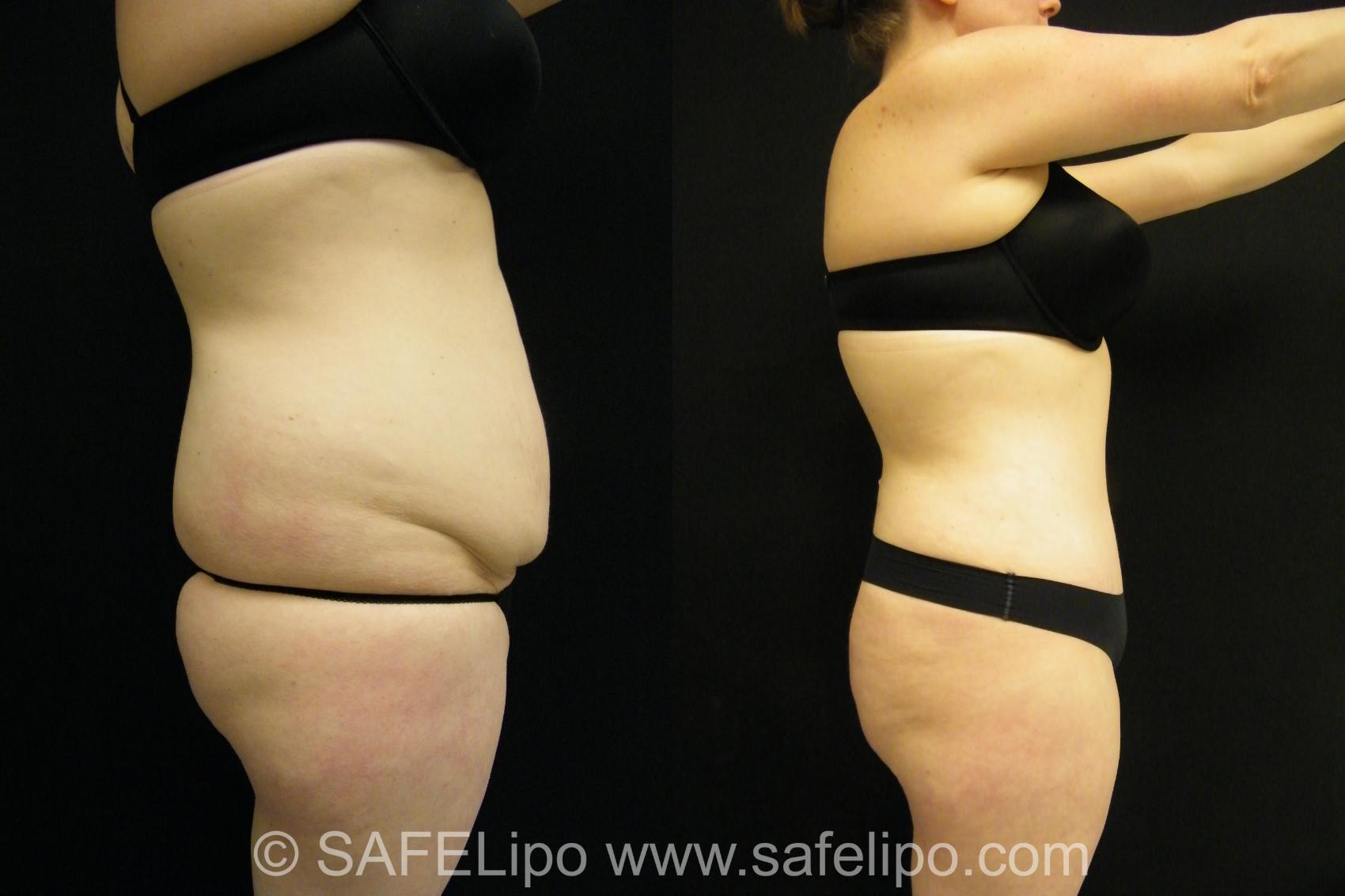 Tummy Tuck Case 398 Before & After View #3 | SAFELipo®