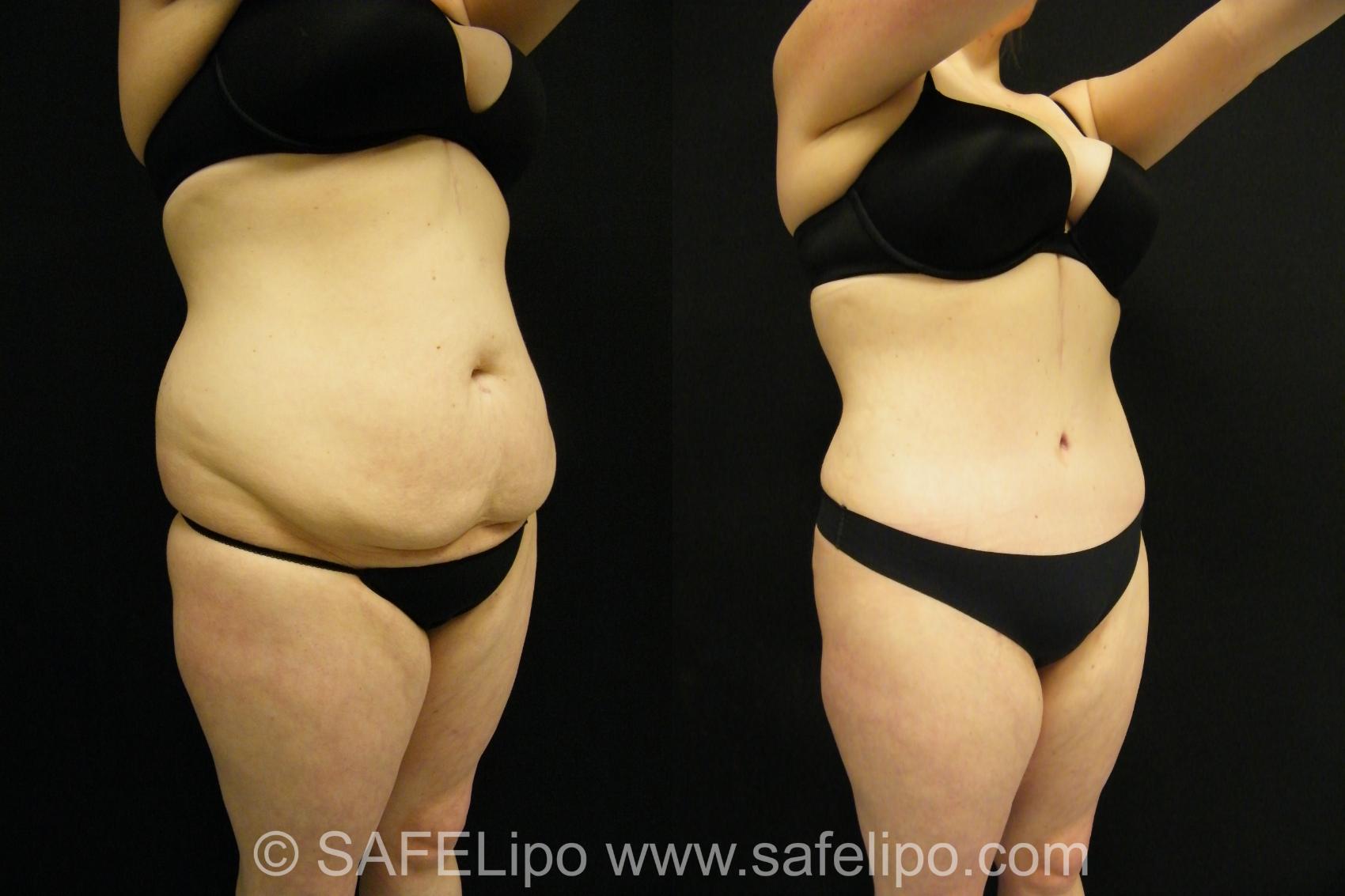 Tummy Tuck Case 398 Before & After View #4 | SAFELipo®